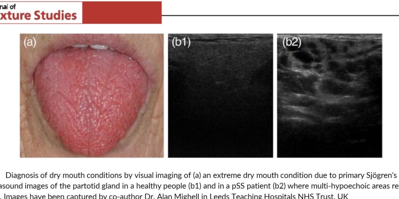 New review article on dry mouth published in Journal of
